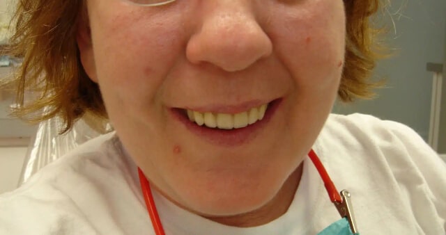 After treatment Image - Dover Family Dentistry - Dentist in Mountain Home AR