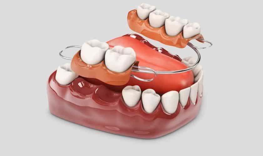 Full-Mouth Dental Implant