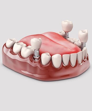 3D dental implant mountain home ar