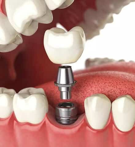 dental implants in mountain home ar