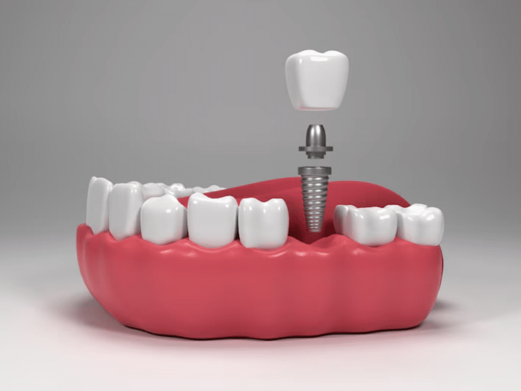 Understanding Dental Implants