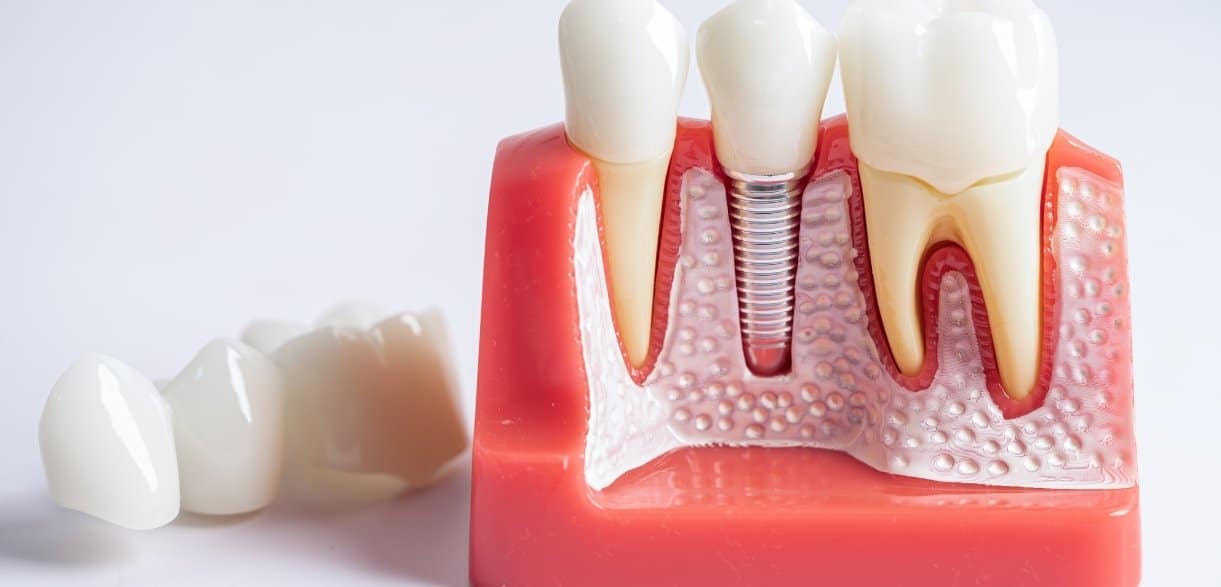know if age is a barrier to dental implants for seniors