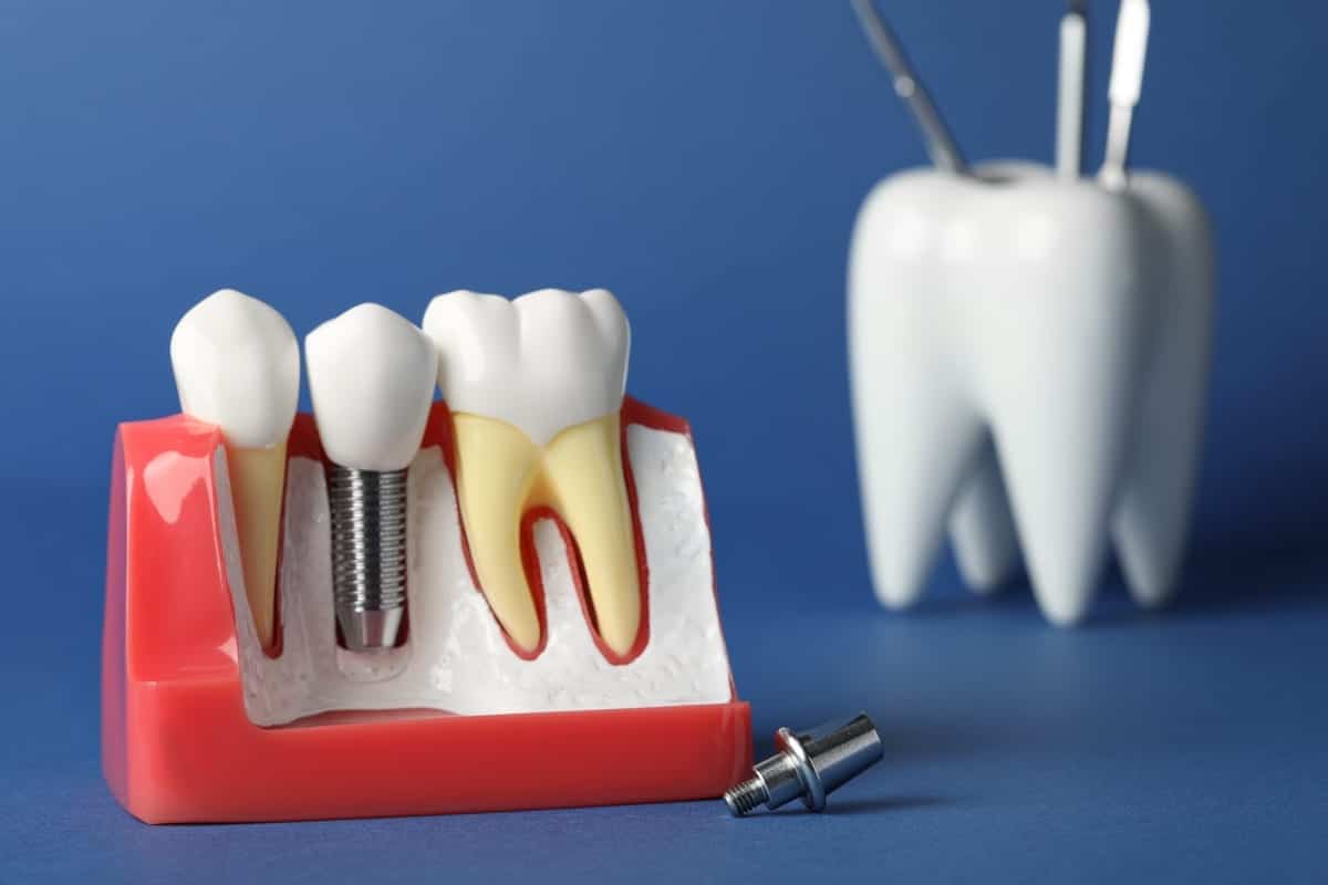 Dental Implants in Mountain Home